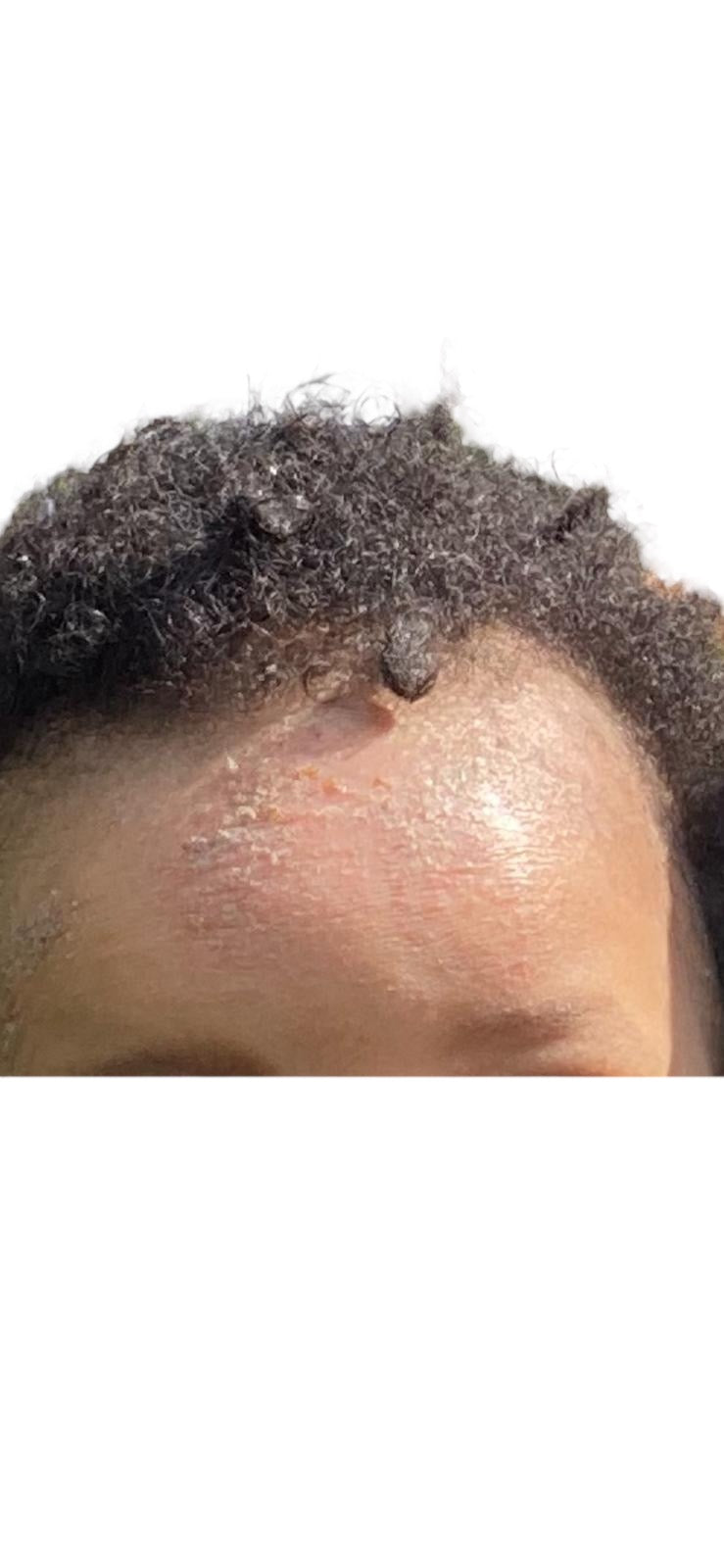 ECZEMA HEALING OIL